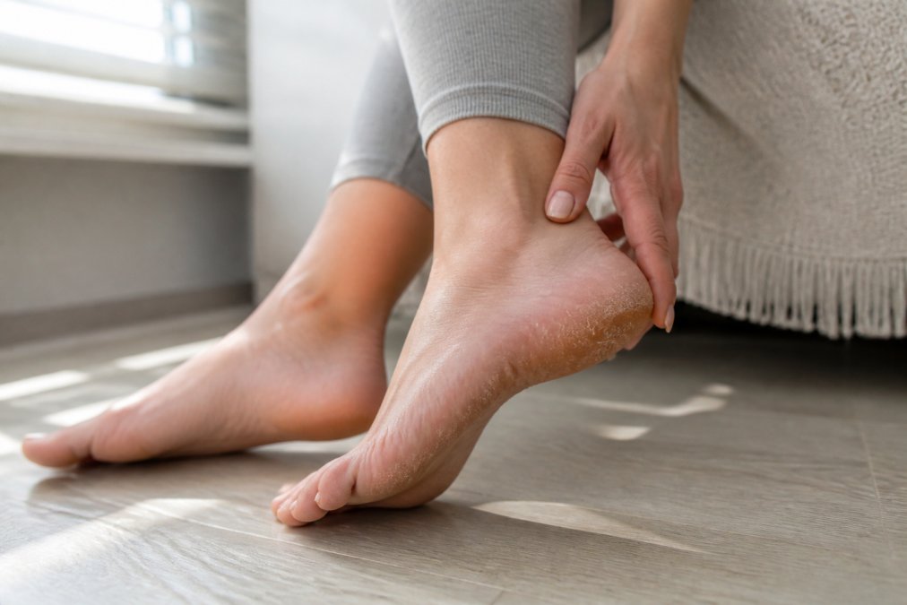 How to Fix Dry Cracked Heels Fast: 4 Steps